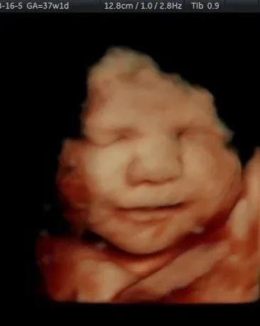 3D ultrasound baby face at 35 weeks