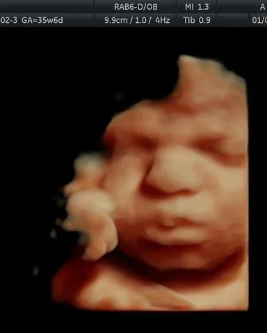 3D ultrasound baby yawning